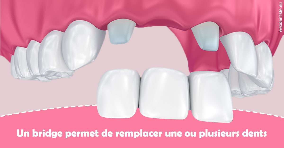https://www.madentiste.paris/Bridge remplacer dents 2
