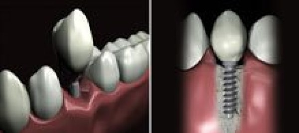 Cas clinique : Les implants dentaires - Dr Grunberg - dentiste à Paris 75012