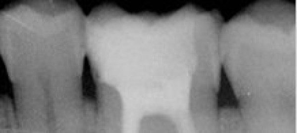 Cas clinique : Traitements endodontiques Dr Grunberg - dentiste à Paris 75012