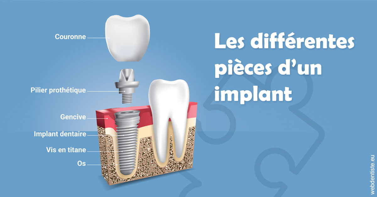 https://www.madentiste.paris/Les différentes pièces d’un implant 1